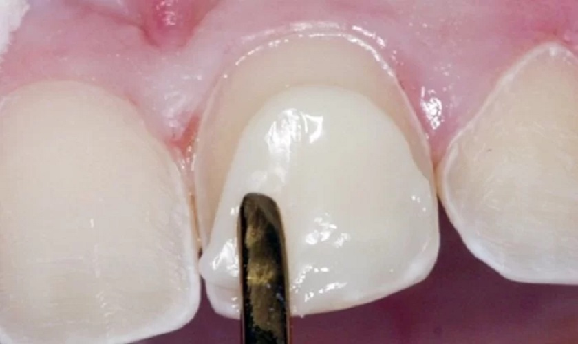 5 điều cần biết trước khi đắp răng khểnh