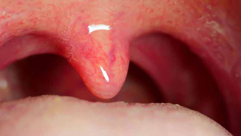 Thế nào là viêm họng lưỡi gà dài: Nguyên nhân, triệu chứng, và cách điều trị