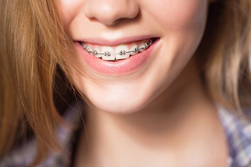 Niềng răng vĩnh viễn: Phương pháp niềng răng hiệu quả nhất